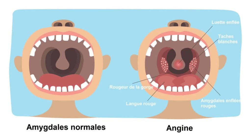 Comment soigner une angine rouge 