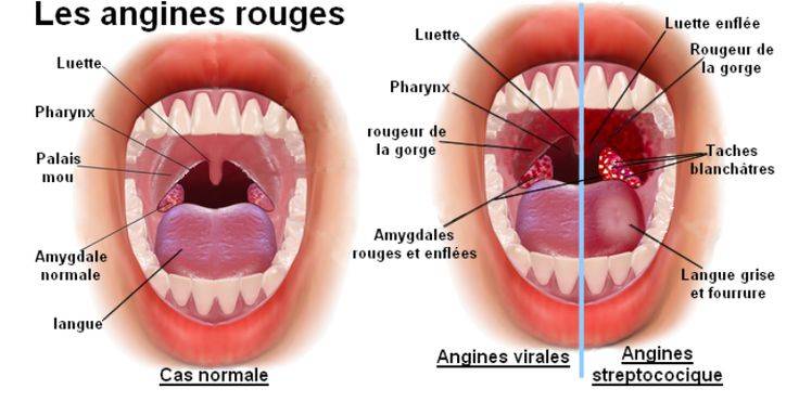 Comment soigner une angine rouge 