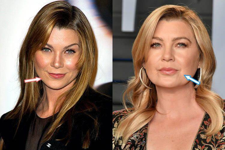 Ellen pompeo chirurgie 