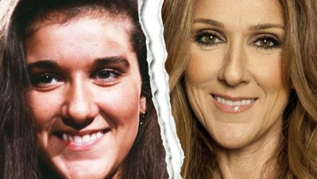 Celine Dion Avant Chirurgie 