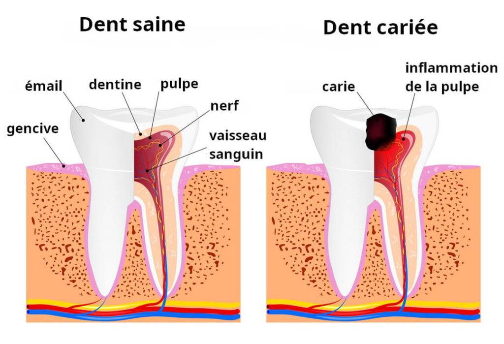 Comment soulager une carie