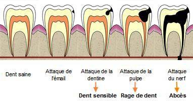 Comment soulager une carie