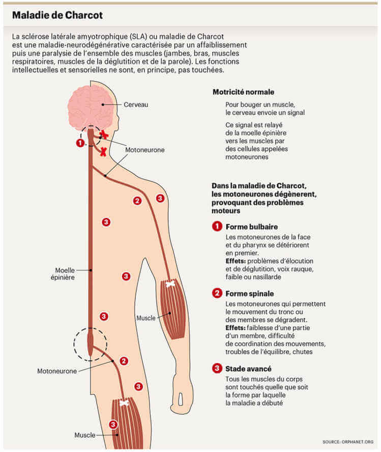 Maladie de charcot héréditaire