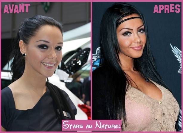 Nabilla avant chirurgie esthétique