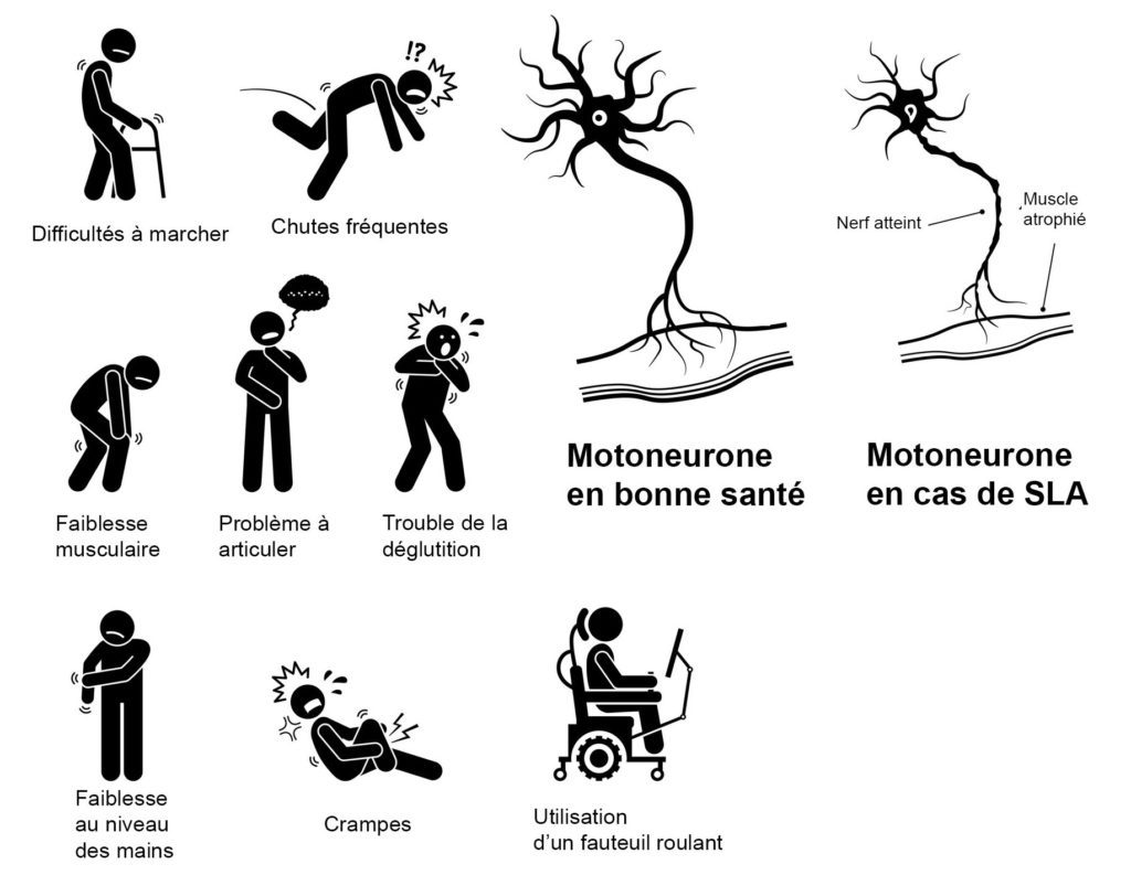 Maladie de charcot héréditaire