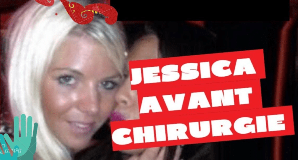 Jessica Avant Chirurgie Esthétique