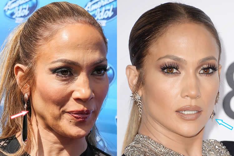 Jennifer lopez chirurgie